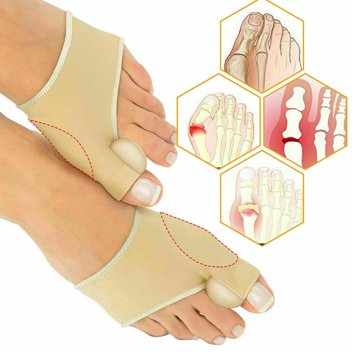 Smart Care Bunion Support Foot Correction Socks – Toe Separator & Bunion Relief
